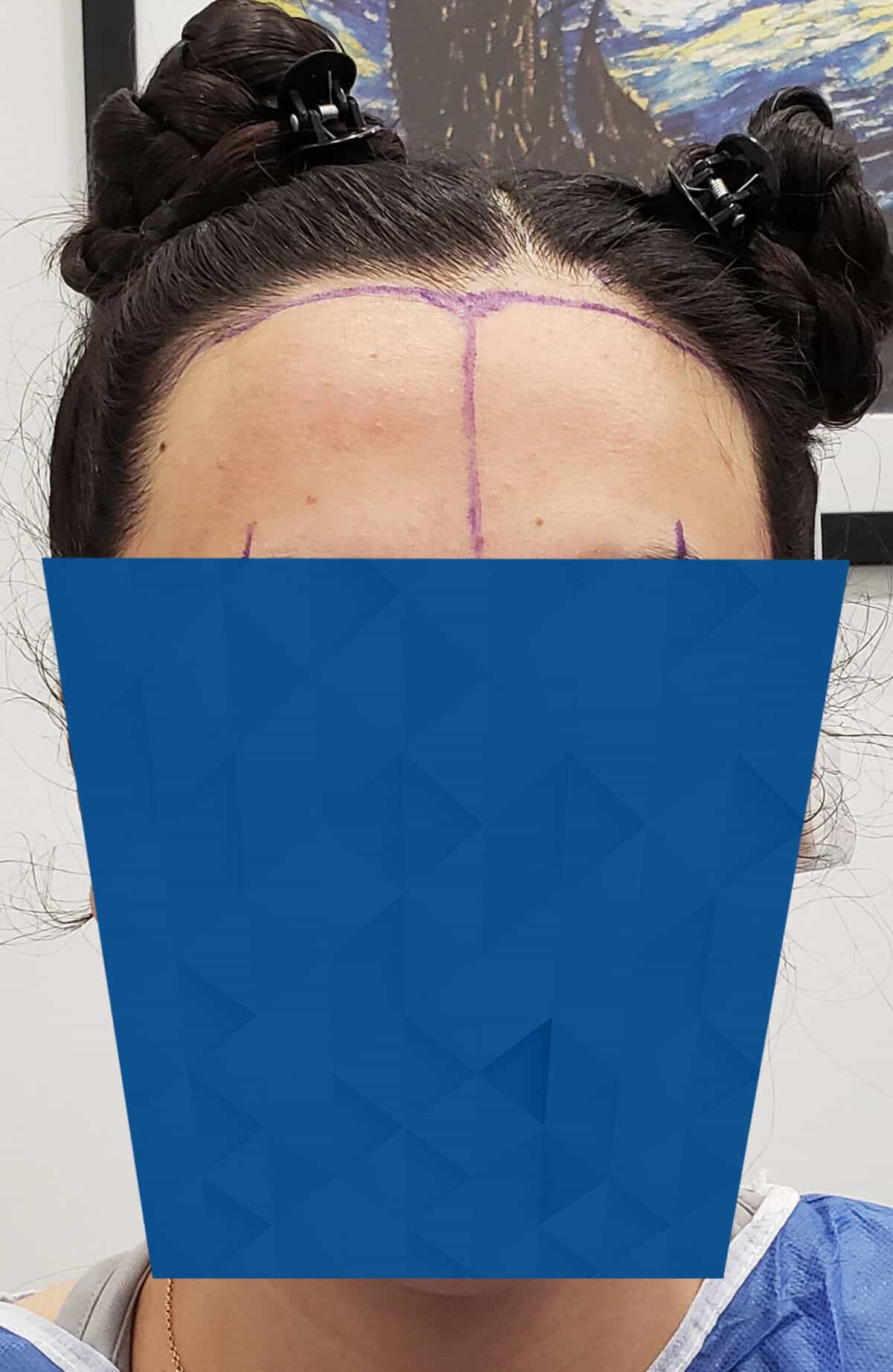 25-30 LalaniF-Before-Front-V2