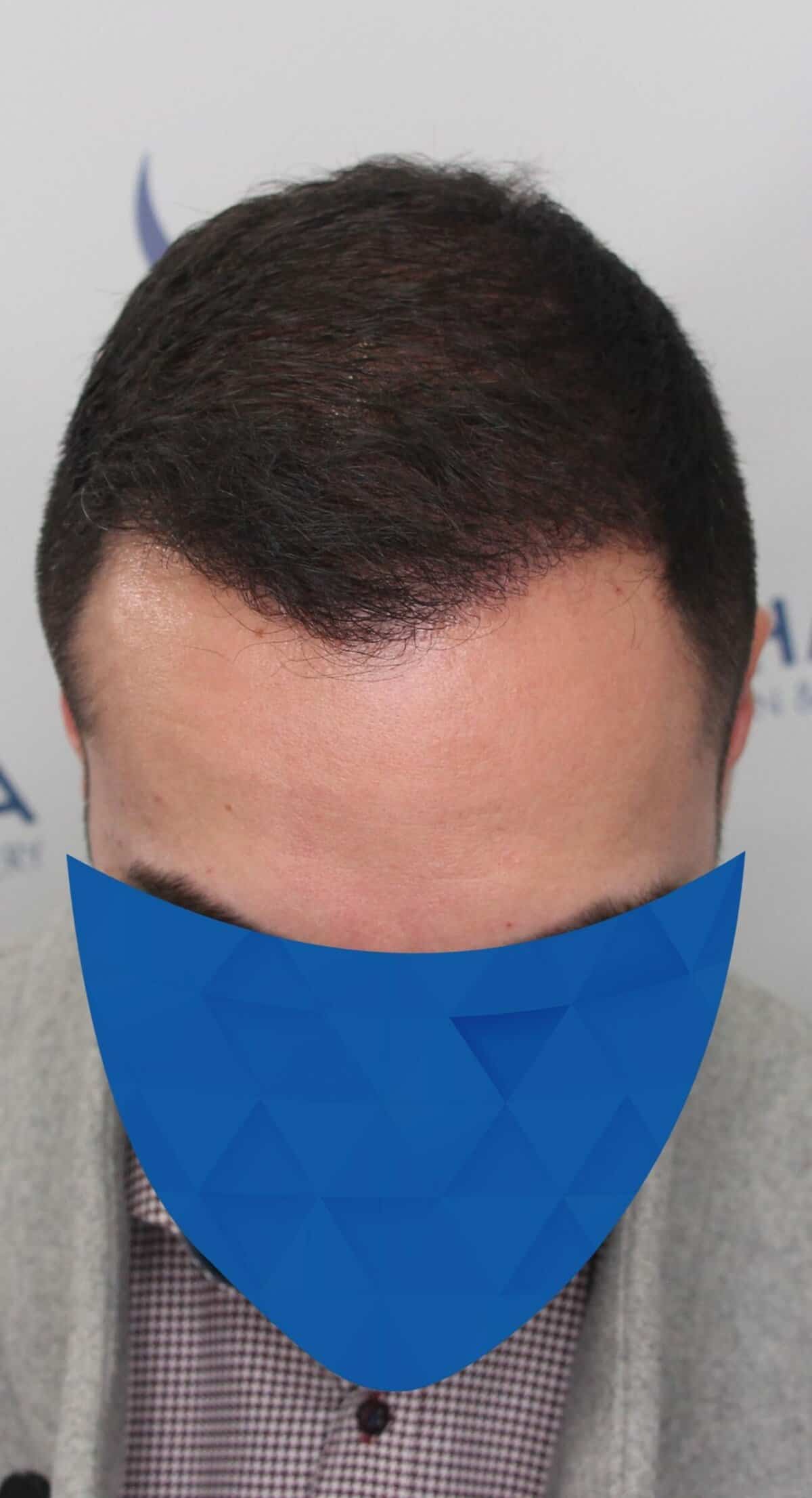 31-year-old-male-after