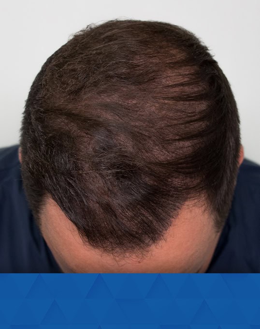 35-Year-Old-Male-_After