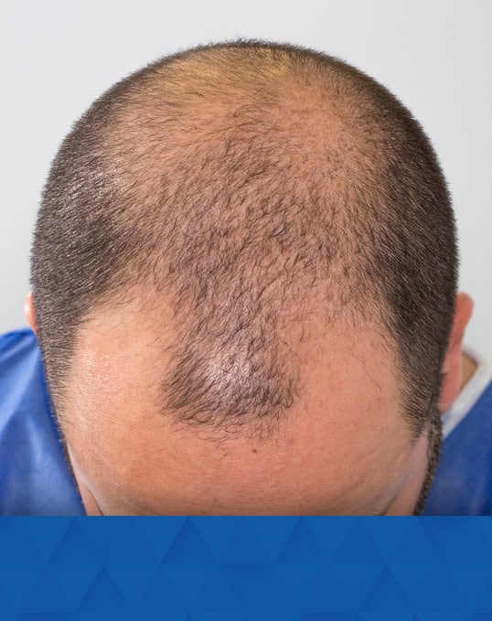 35-Year-Old-Male-_Before