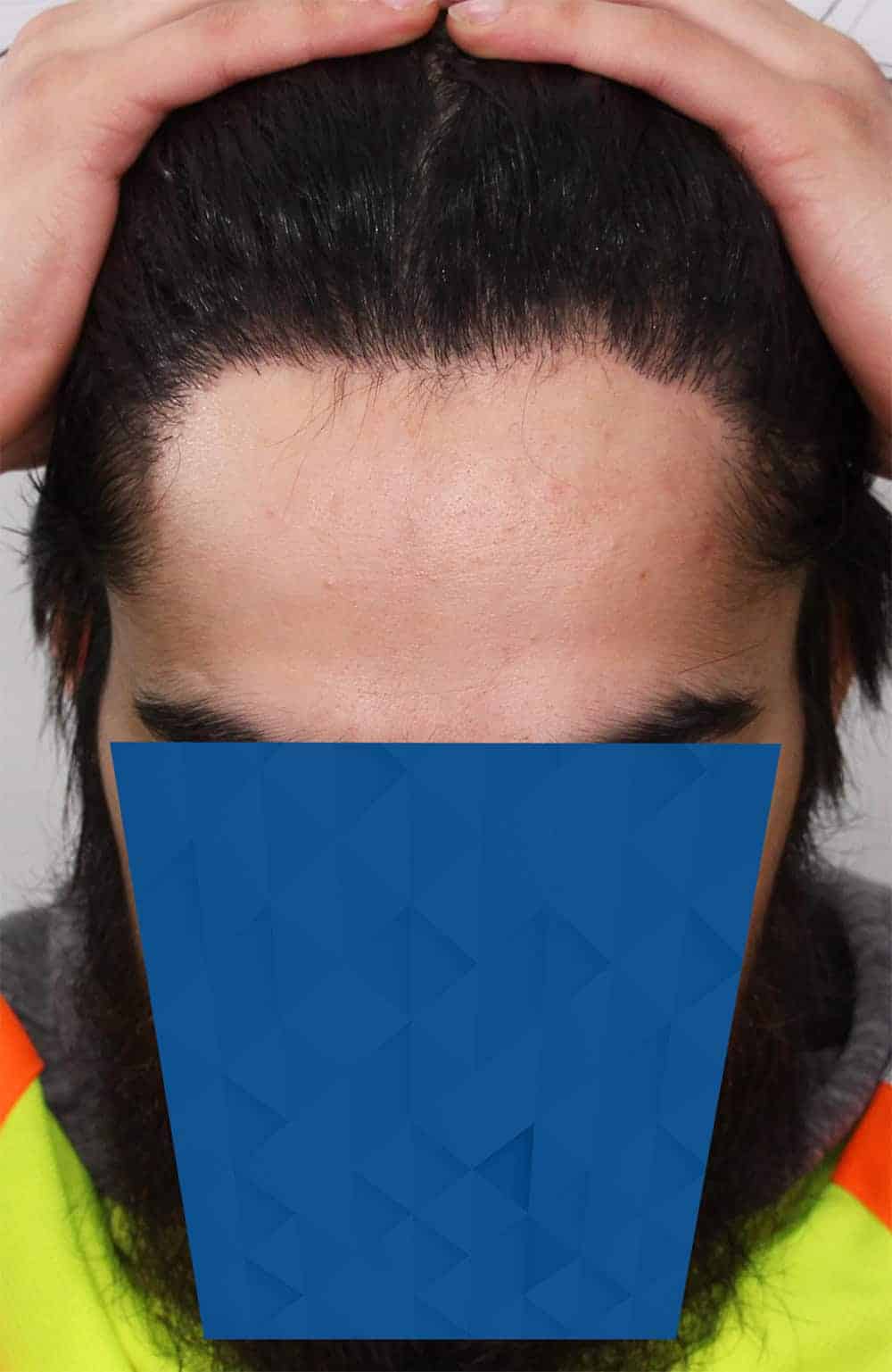 AFTER_1-FUE-hairline-hair-transplant