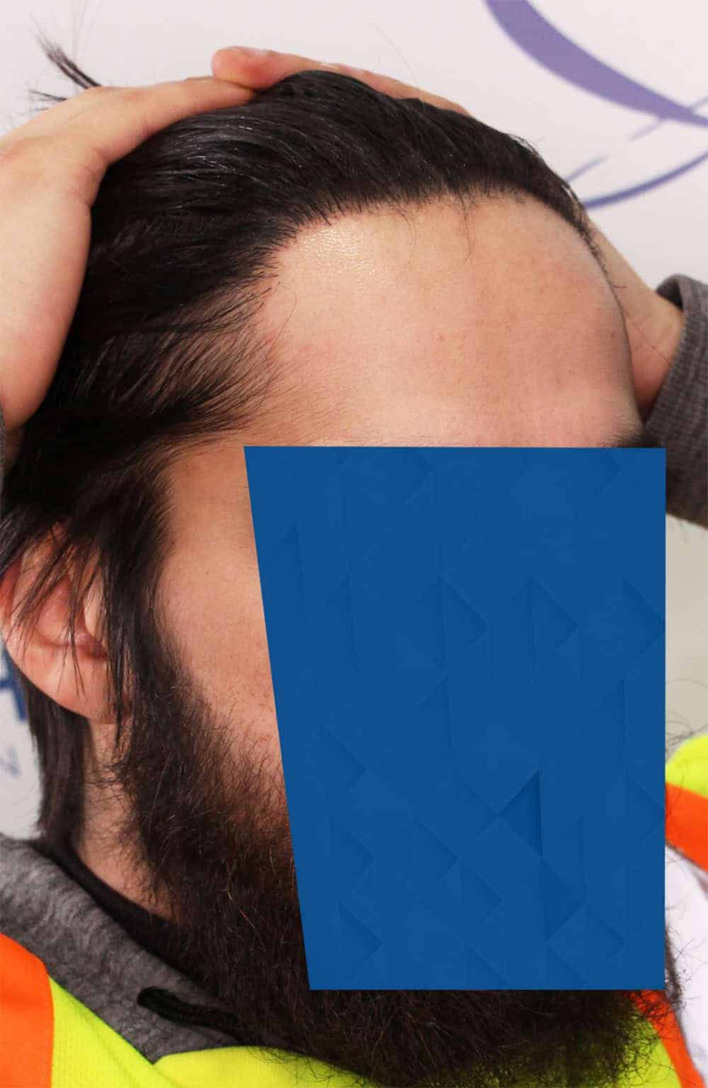 AFTER_2-FUE-hairline-hair-transplant