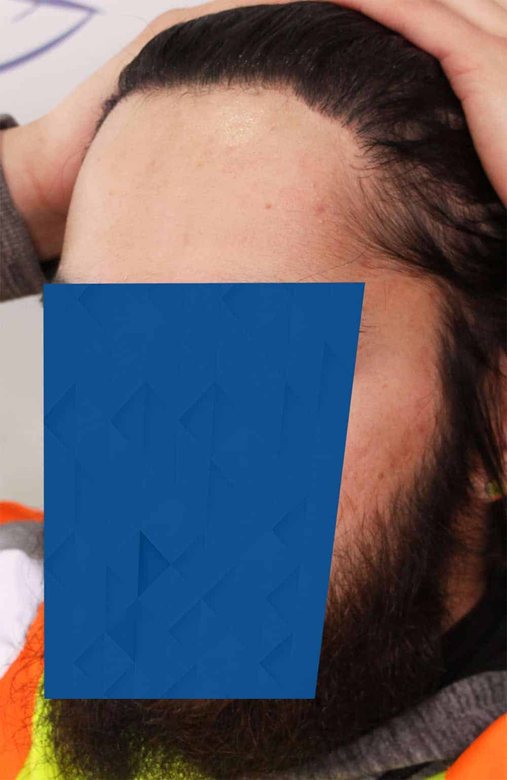 AFTER_3-FUE-hairline-hair-transplant