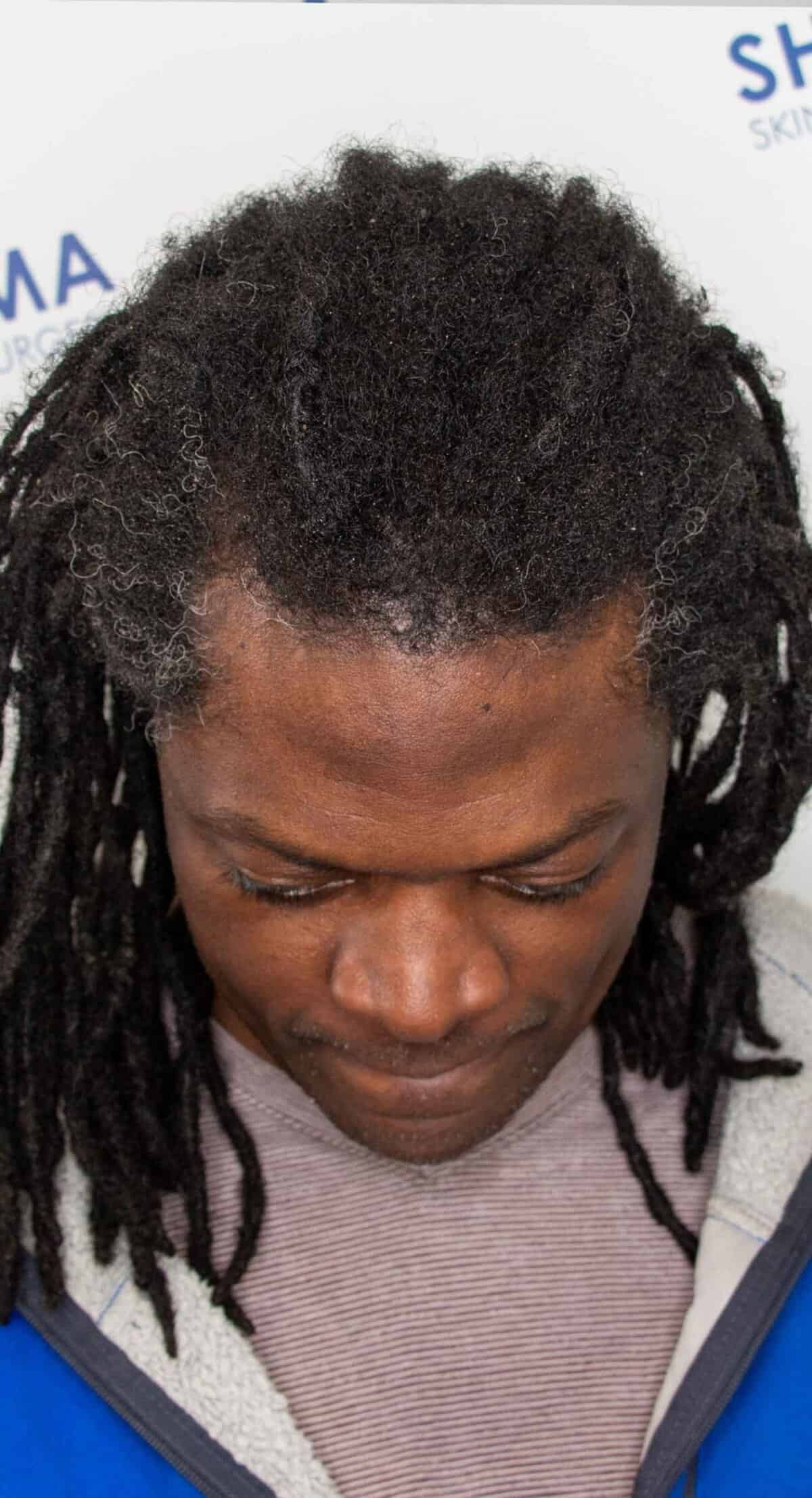 Aka_Front_After_Surgery