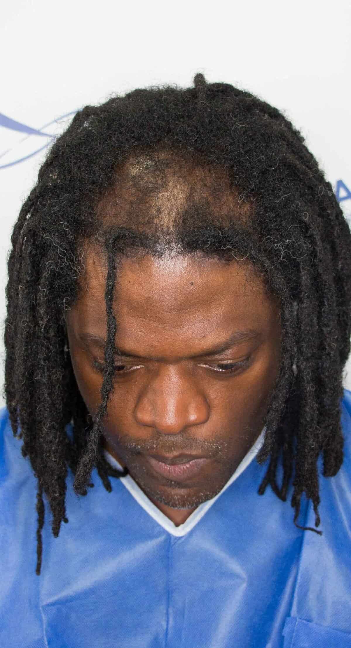 Aka_Front_Before_Surgery