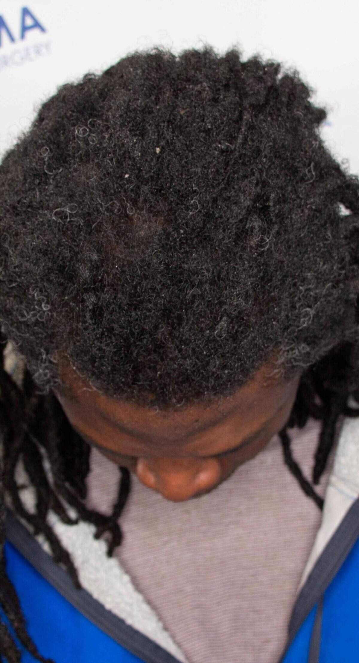 Aka_Top_After_Surgery