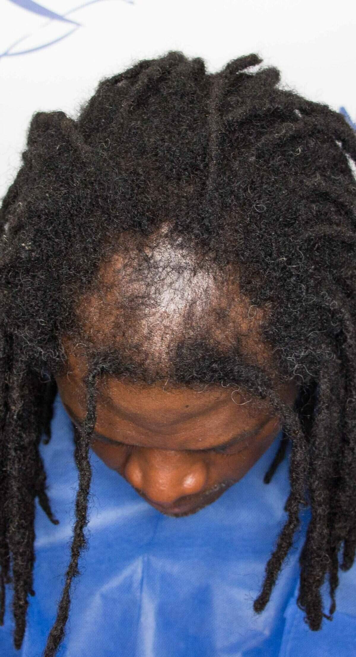 Aka_Top_Before_Surgery