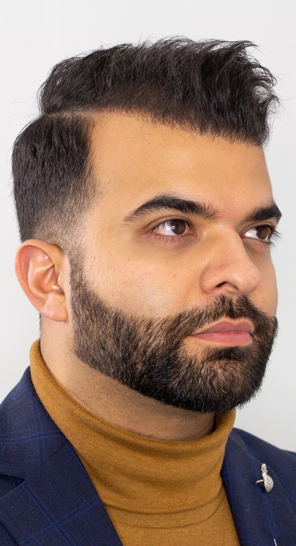 Aly-After-Photo-HAir-Transplant-Result-angled