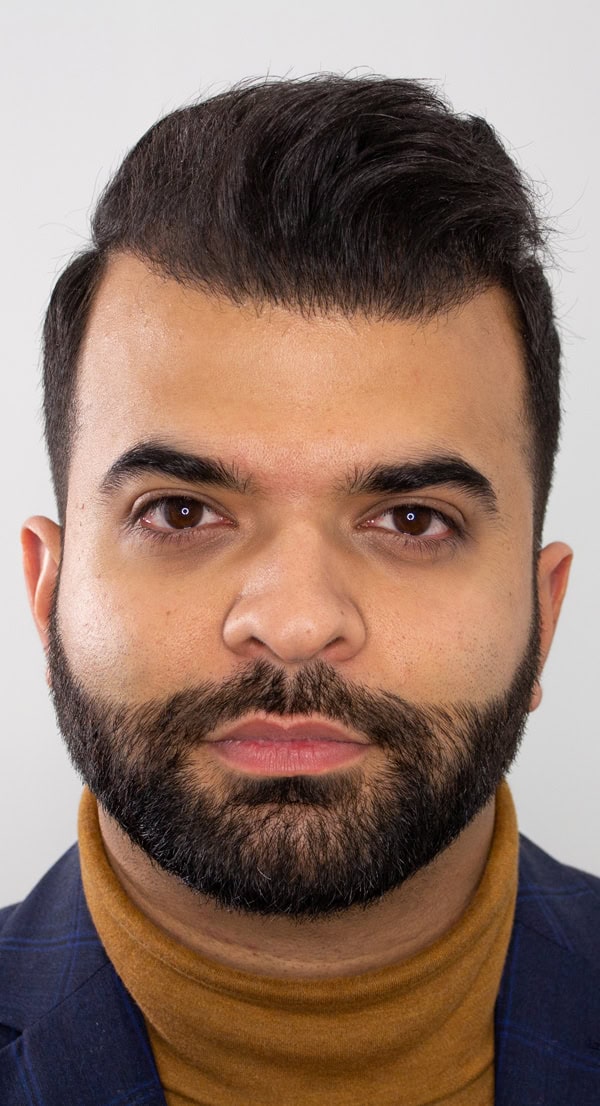 Aly-Front-Hair-Transplant-After-Photo-1