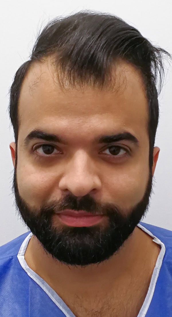 Aly-Front-Hair-Transplant-Before-Photo-1