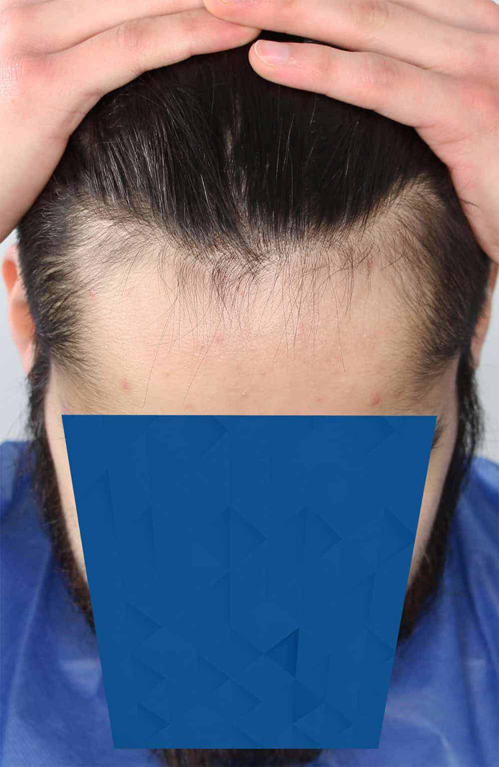 BEFORE_1-FUE-hairline-hair-transplant