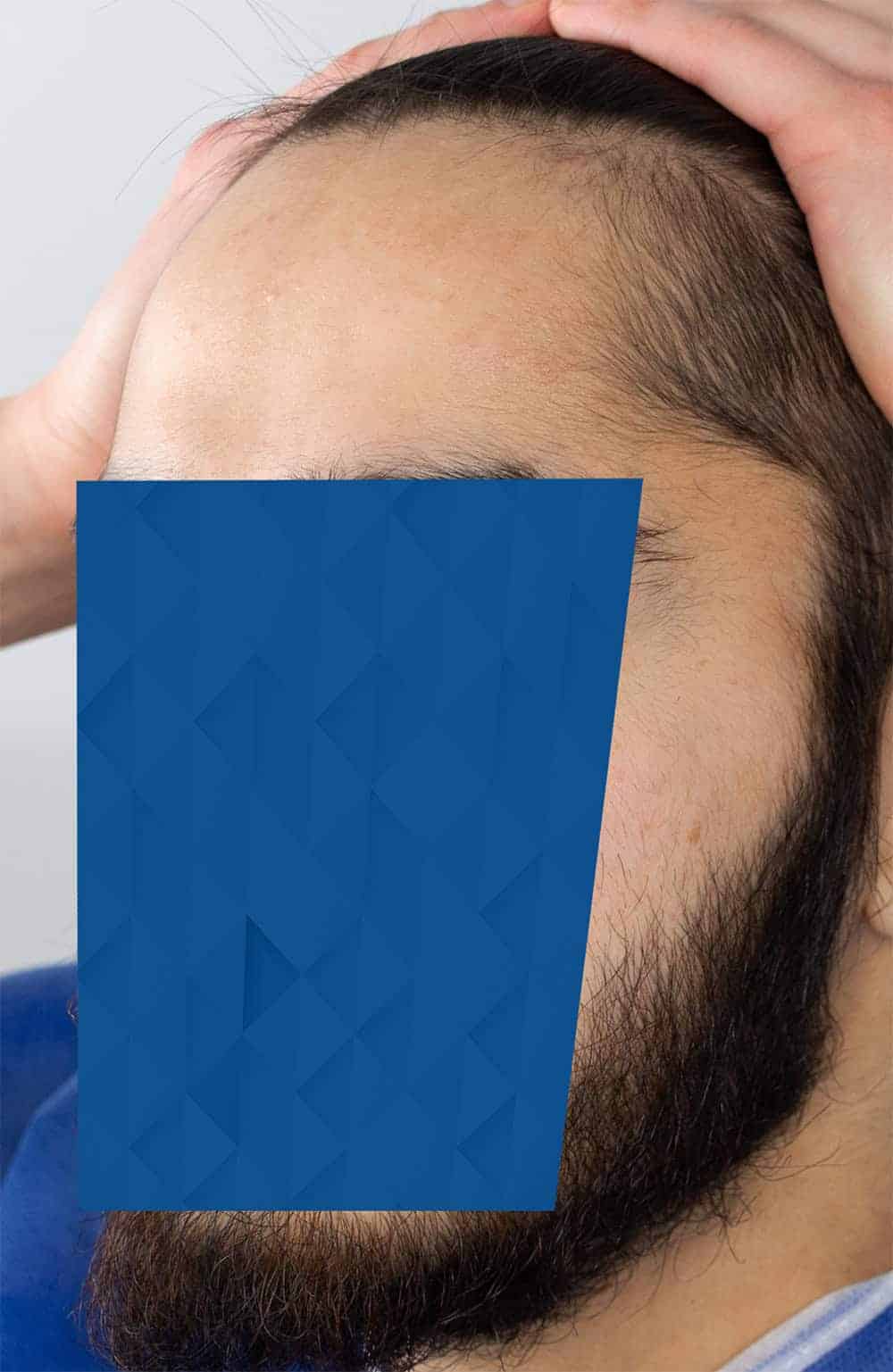BEFORE_3-FUE-hairline-hair-transplant