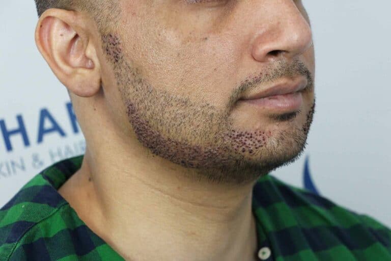 Beard transplant Edmonton