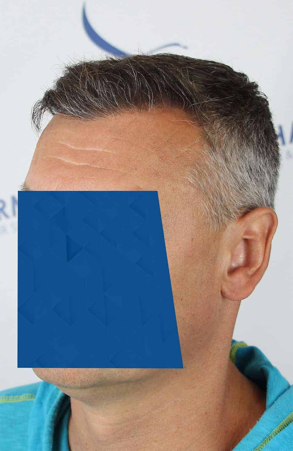 Danail-D-After-45Left-2500-grafts
