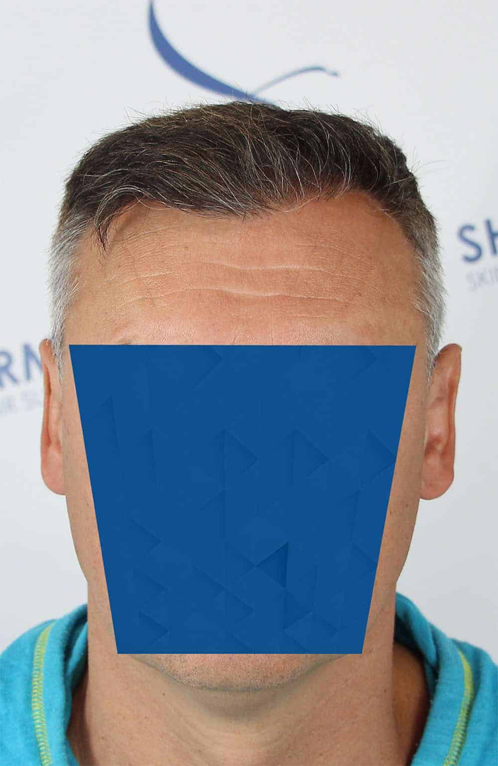 Danail-D-After-Front-2500-grafts