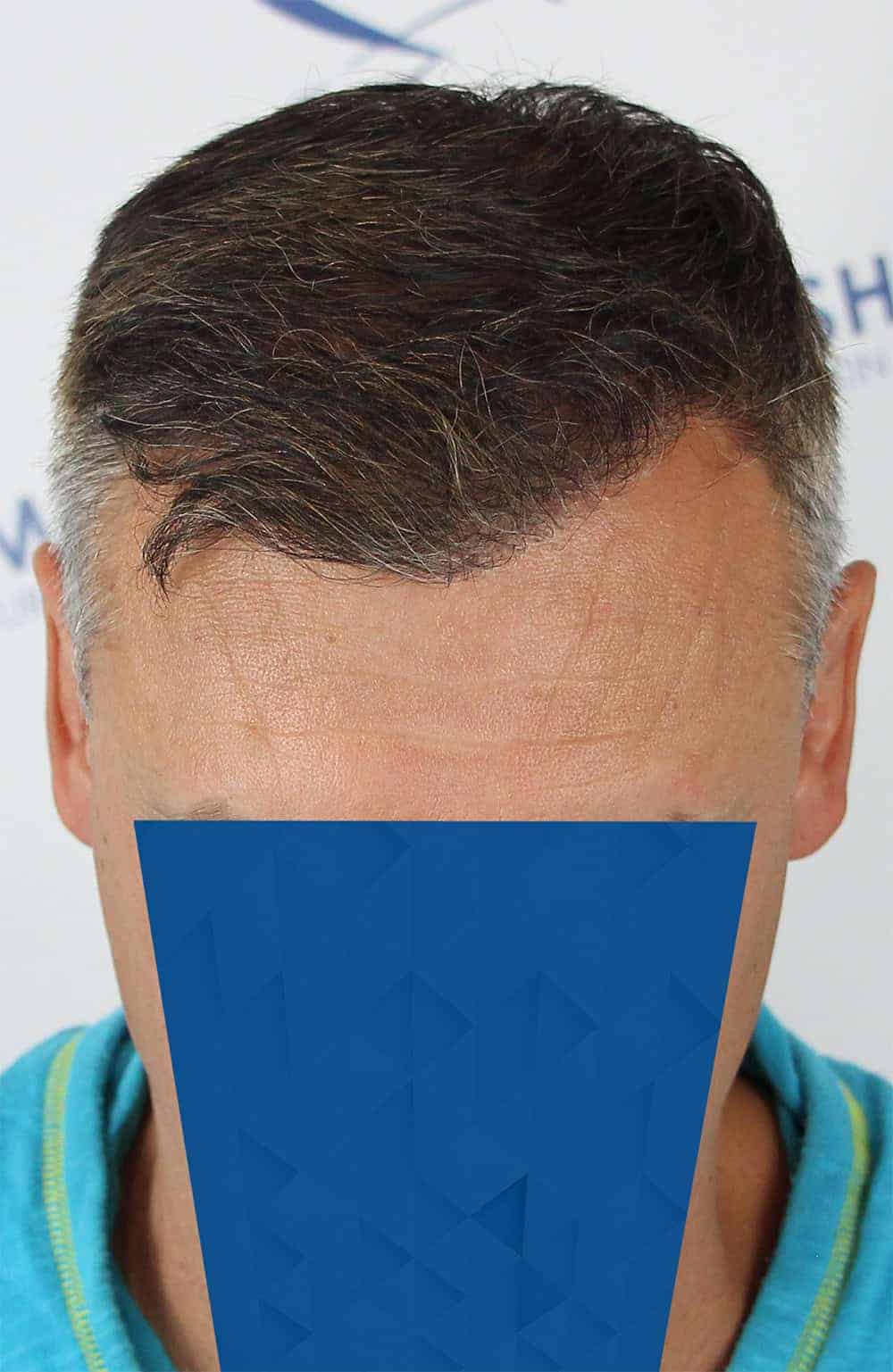 Danail-D-After-Front-Tilt-2500-grafts