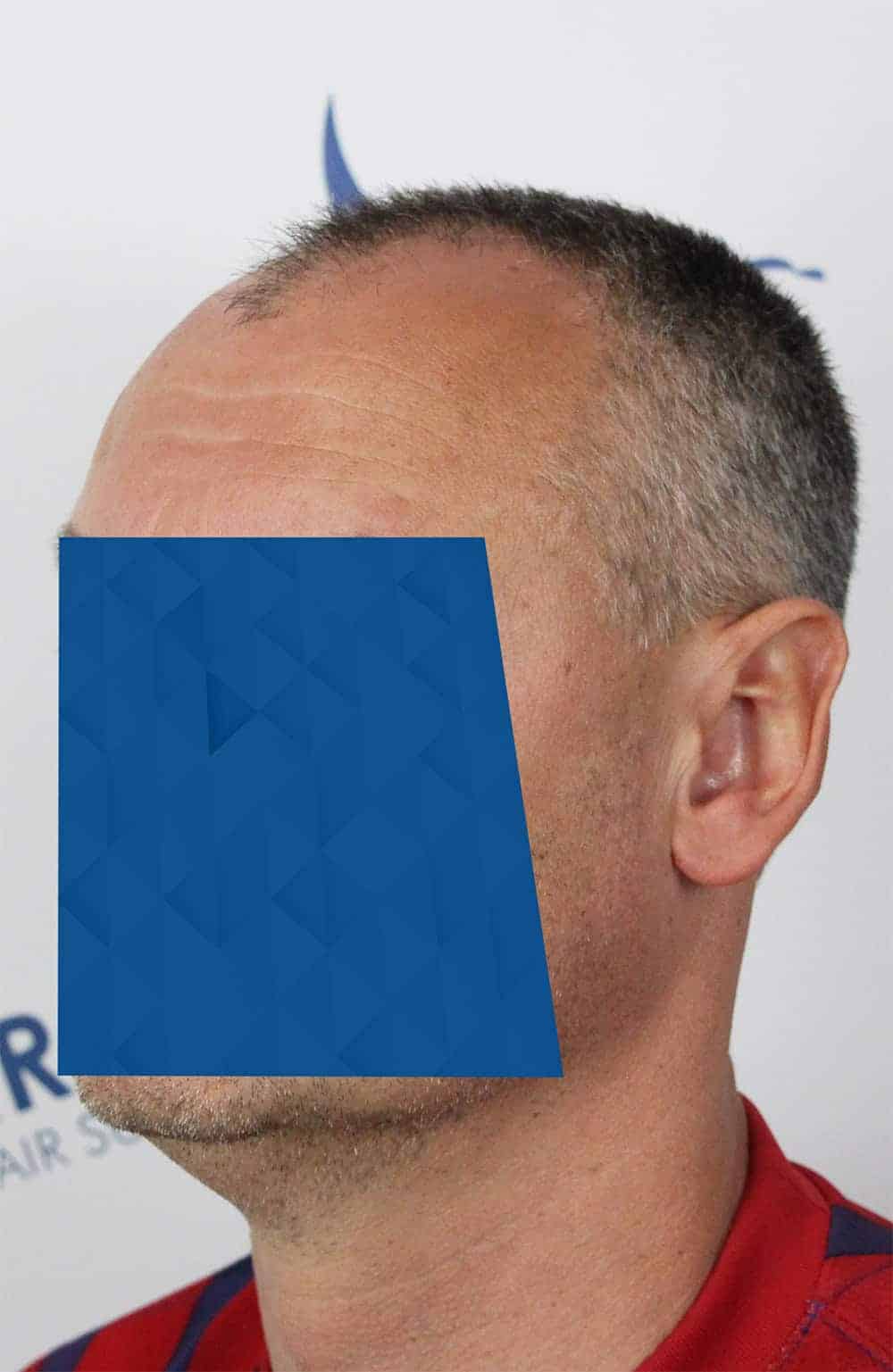 Danail-D-Before-45Left-2500-grafts