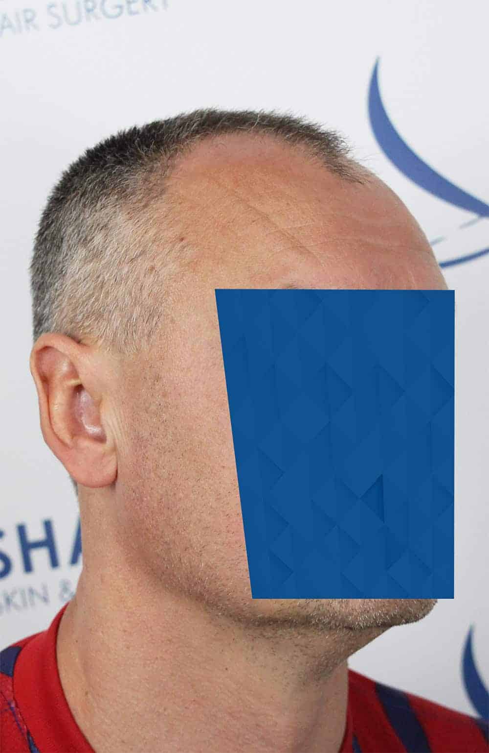 Danail-D-Before-45Right-2500-grafts