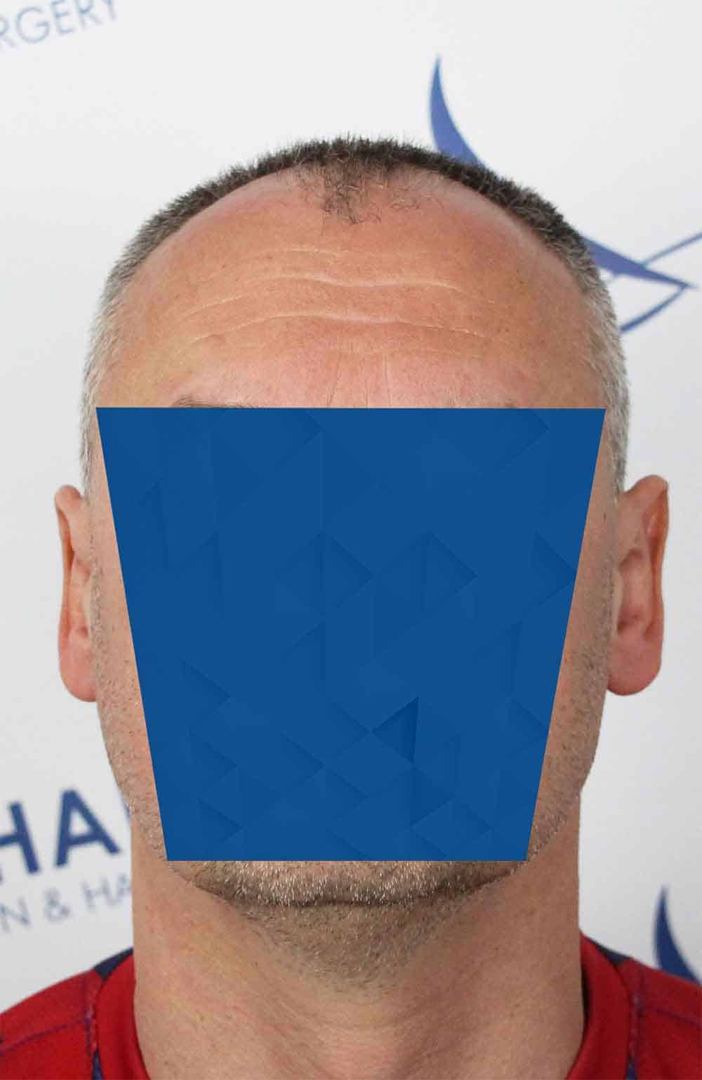 Danail-D-Before-Front-2500-grafts