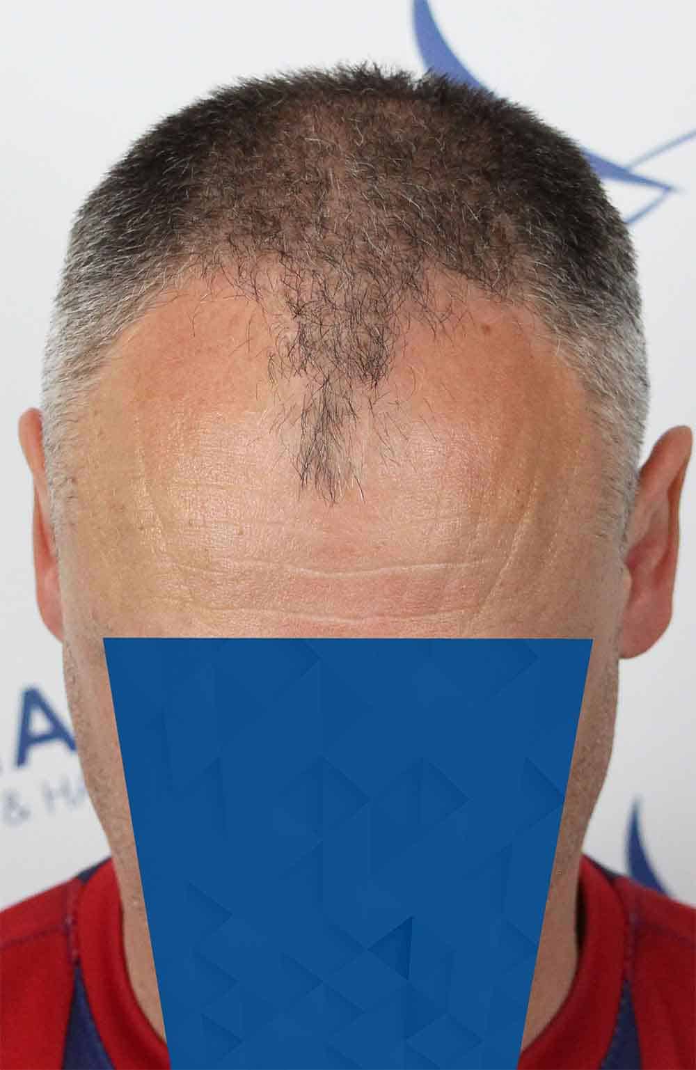 Danail-D-Before-Front-Tilt-2500-grafts
