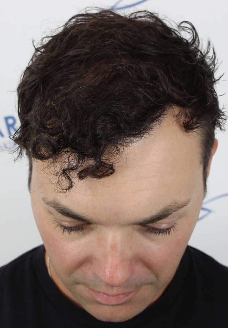 David-After-Front-Tilt
