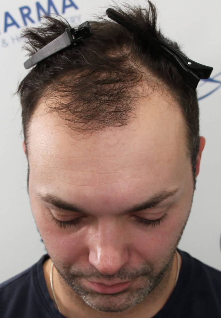 David-Before-Front-Tilt