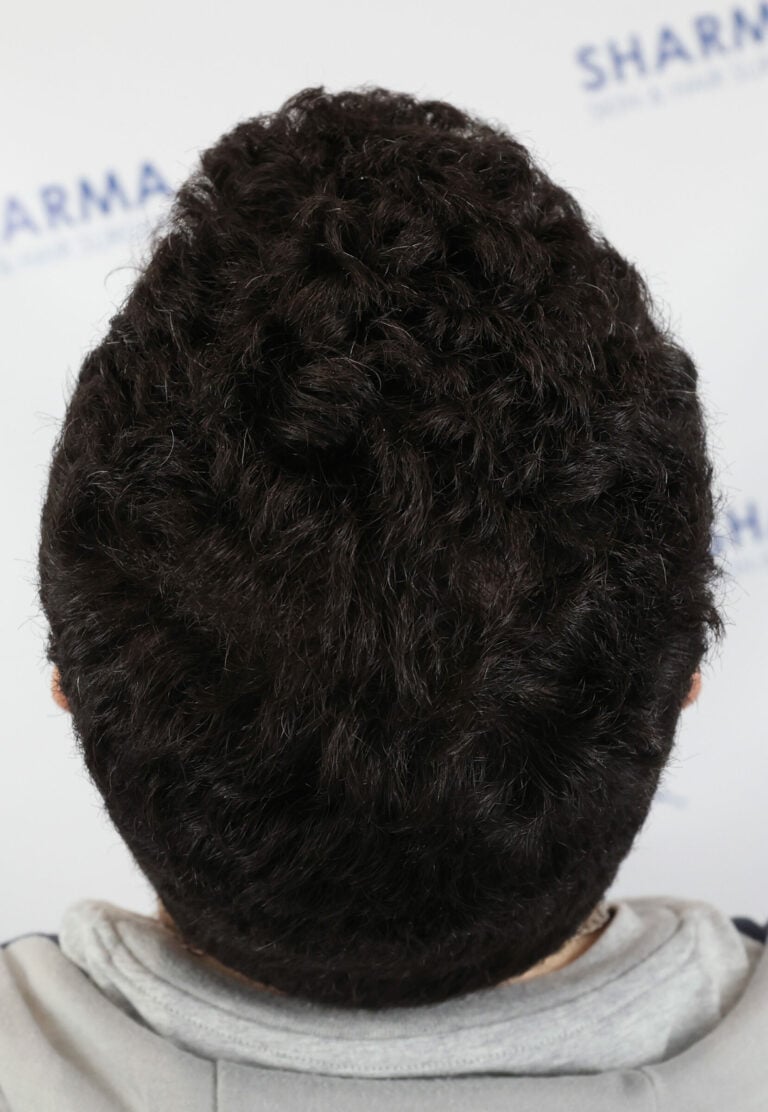 Dawoad-After-34yo-1500-grafts-crown-area-Back