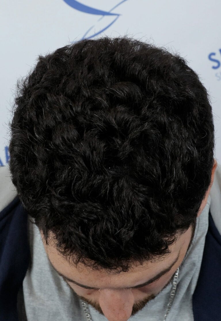 Dawoad-After-34yo-1500-grafts-crown-area-Front