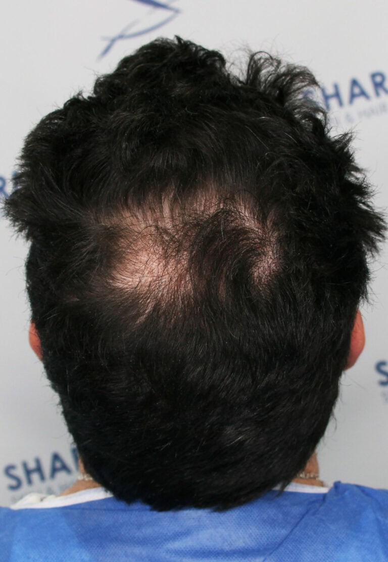 Dawoad-Before-34yo-1500-grafts-crown-area-Back