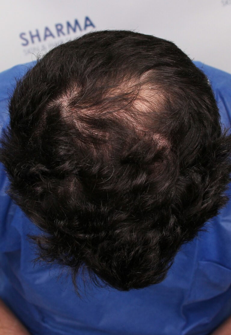 Dawoad-Before-34yo-1500-grafts-crown-area-Front