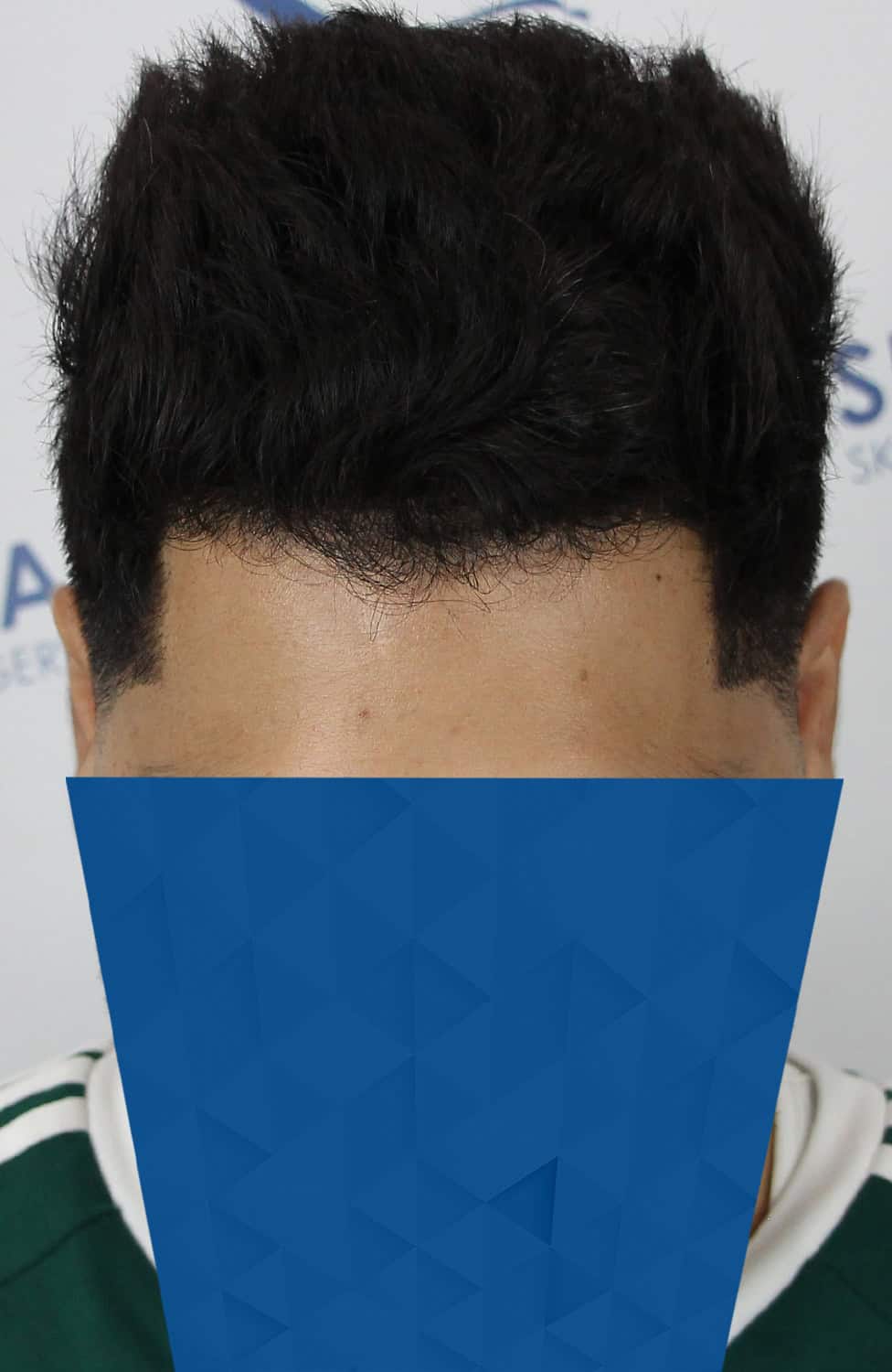 Gur-After-Front-Tilt