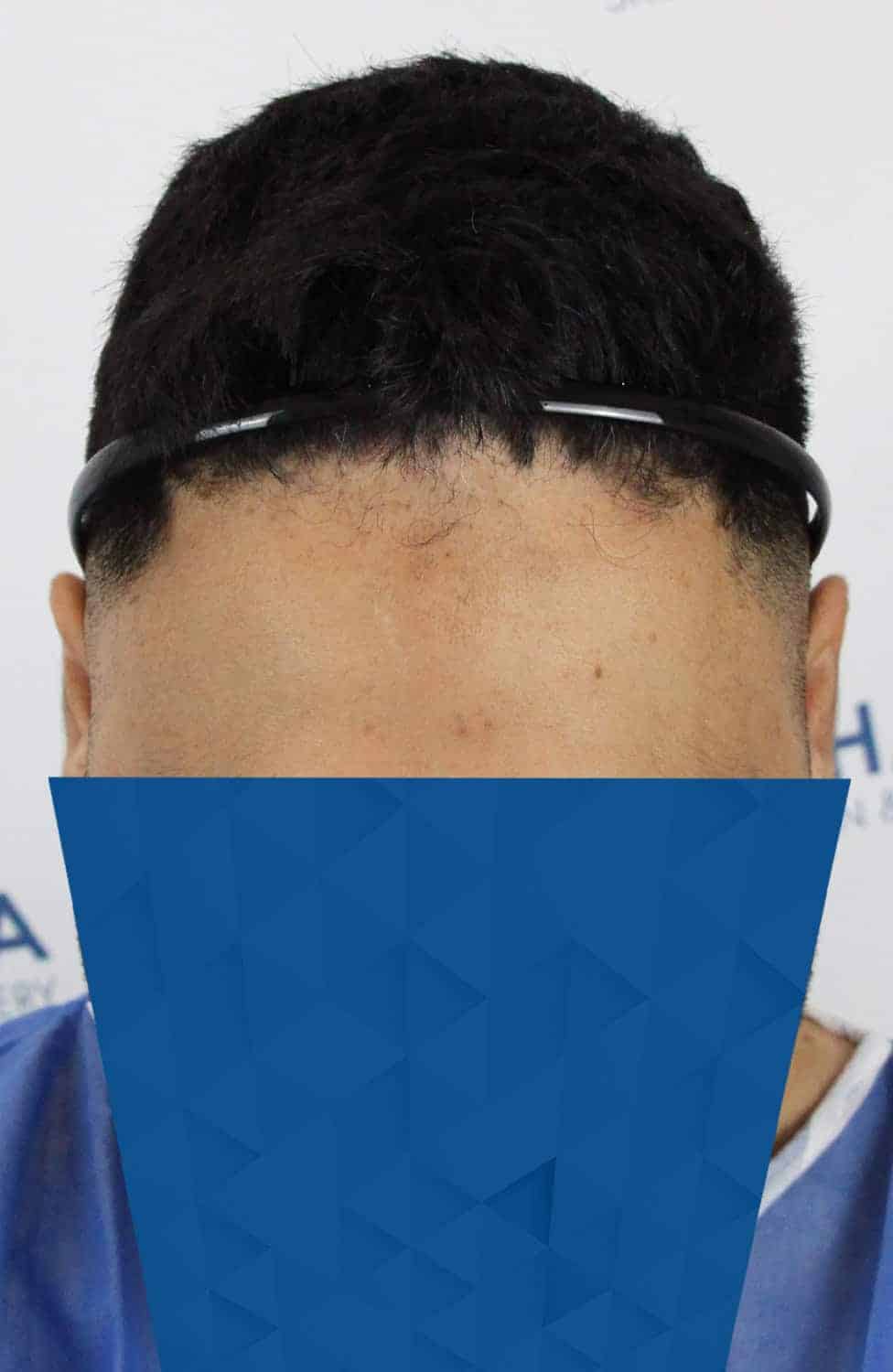 Gur-Before-Front-Tilt