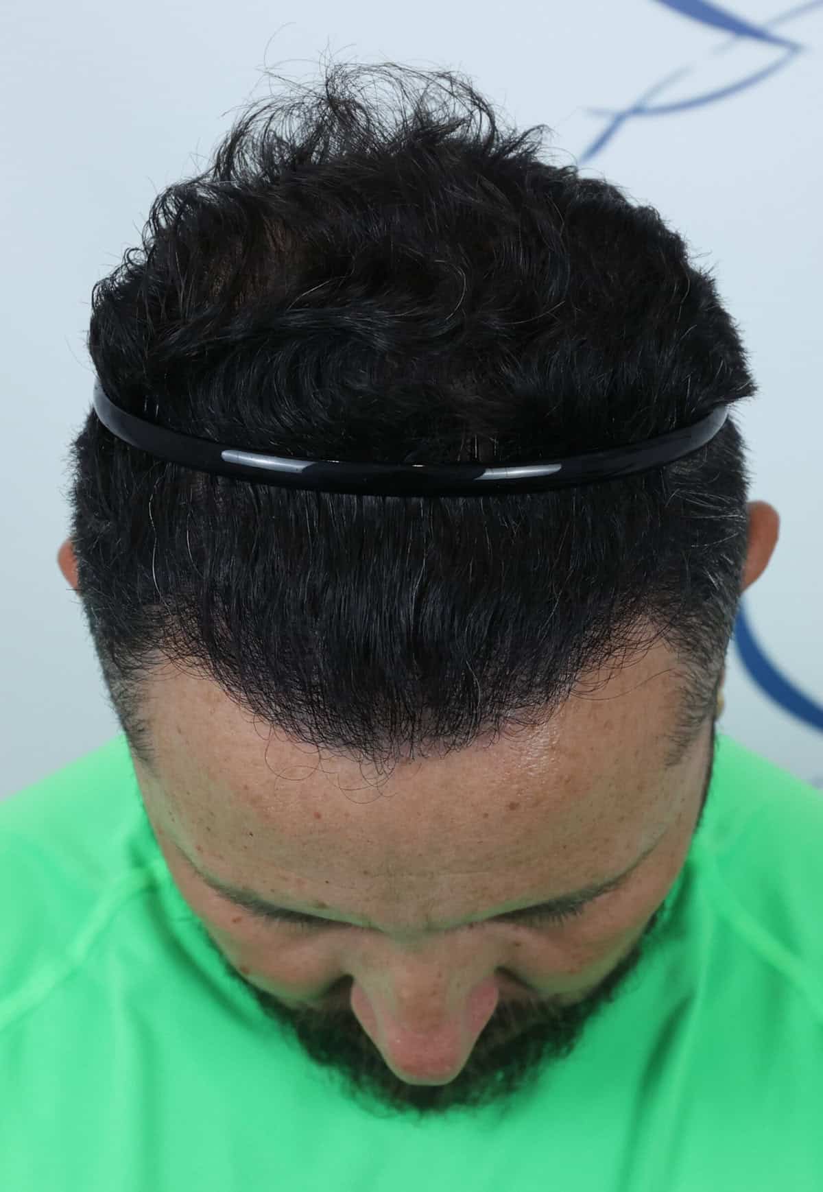 Juan-After-Front-Tilt