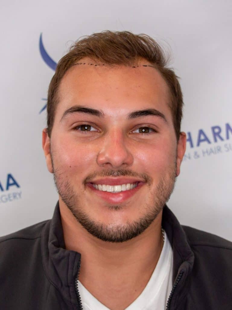 Kaleb-Dahlgren-before-hair-surgery-smiling