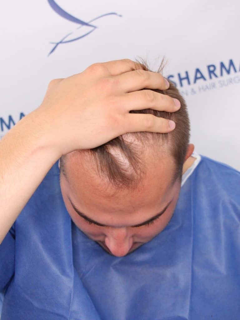 Kaleb-Dahlgren-before-hair-transplant