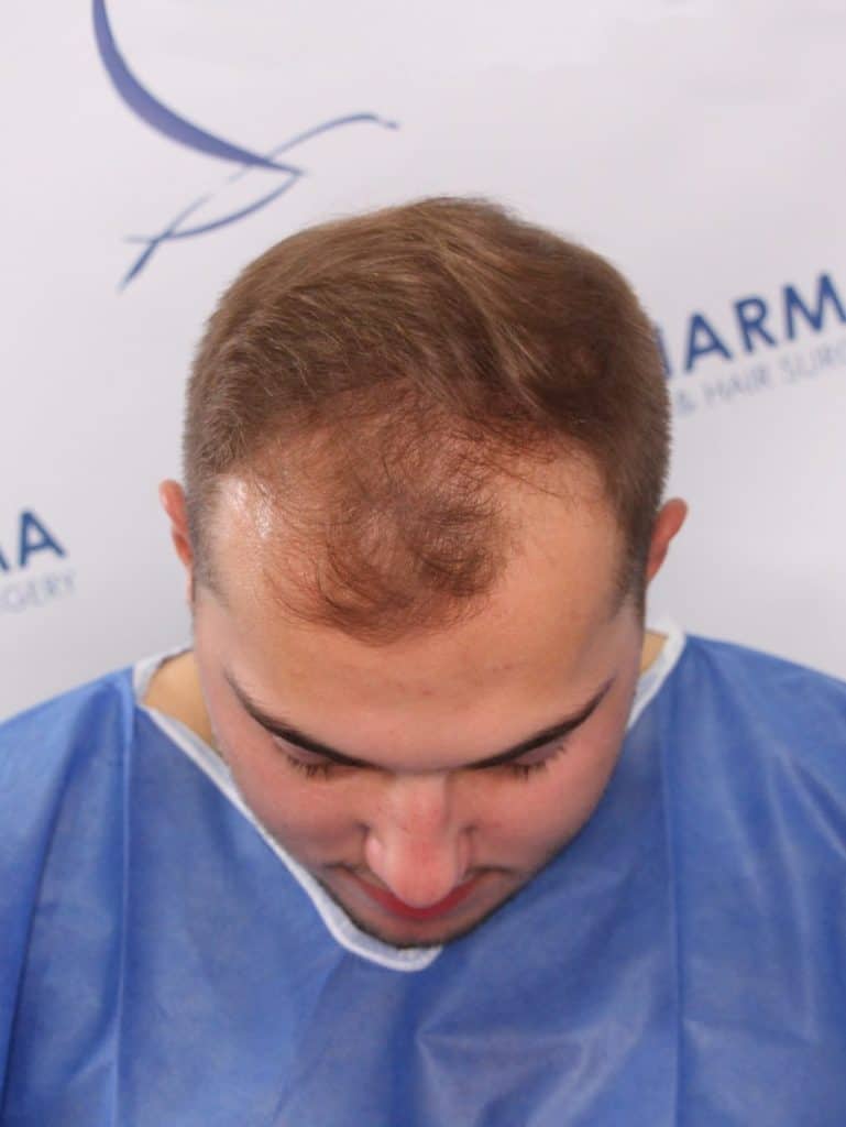 Kaleb-Dahlgren-before-hair-transplant-top