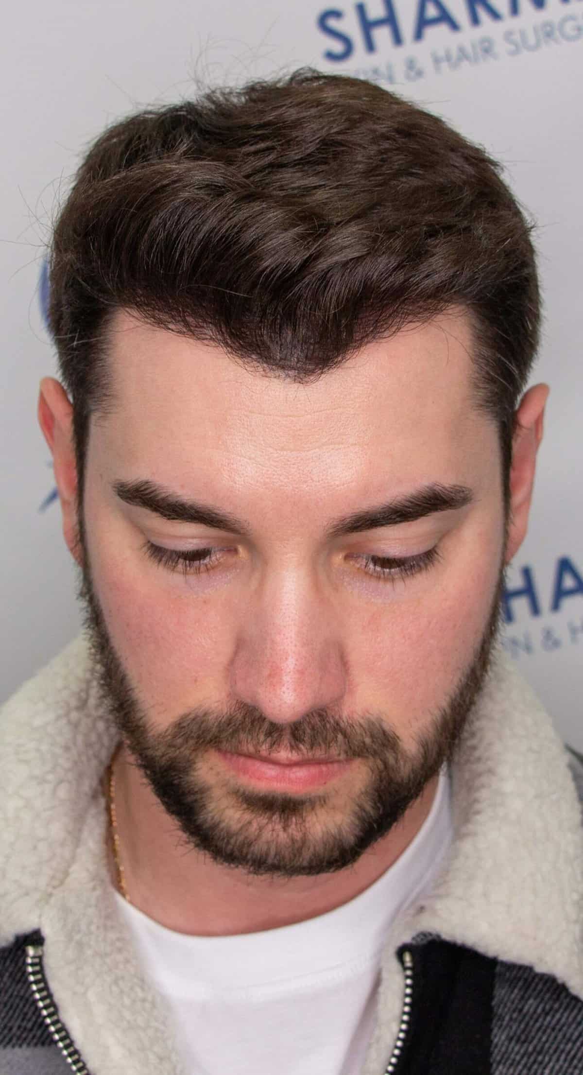 Matt-R-front-top-after