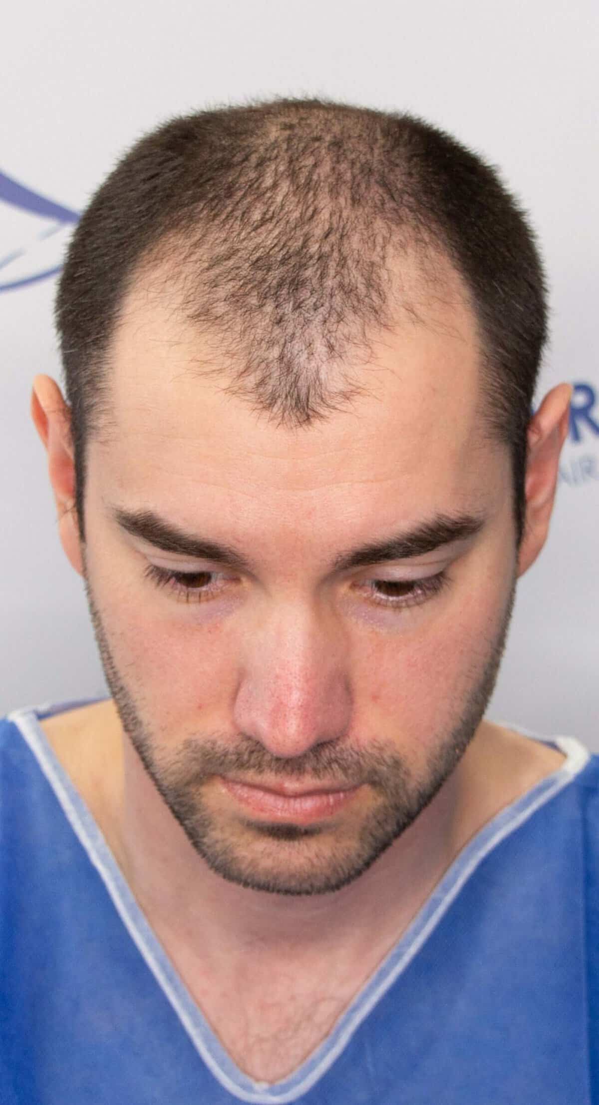 Matt-R-front-top-before