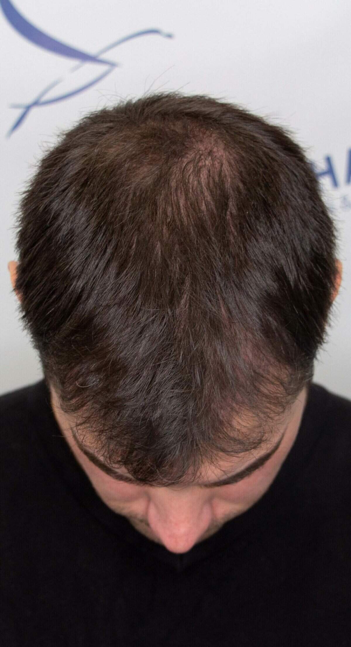 Matthew-after-hair-transplant-crown-front