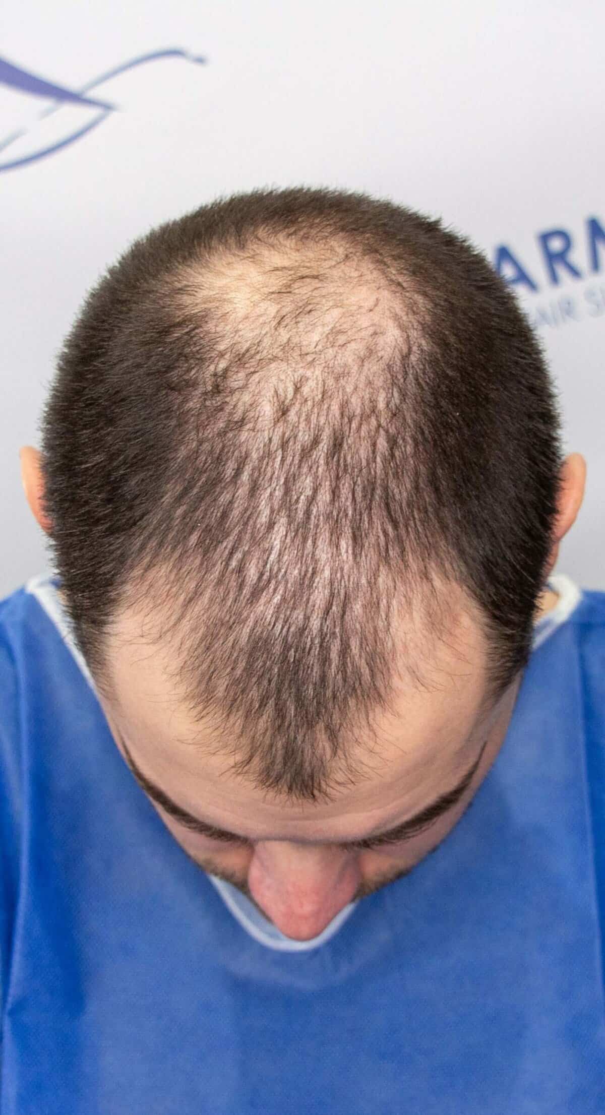 Matthew-before-hair-transplant-crown-front