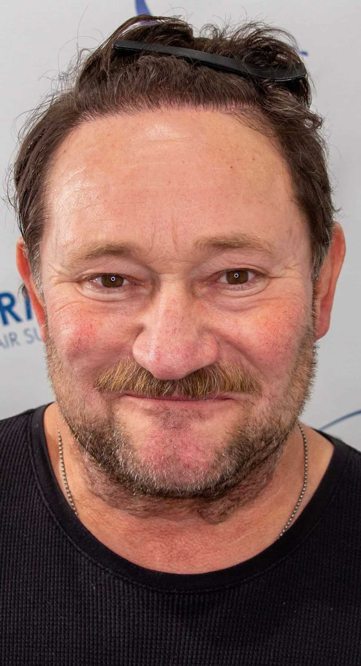 Robert_1_year_Hair_Transplant_Result_Front_hairback_After