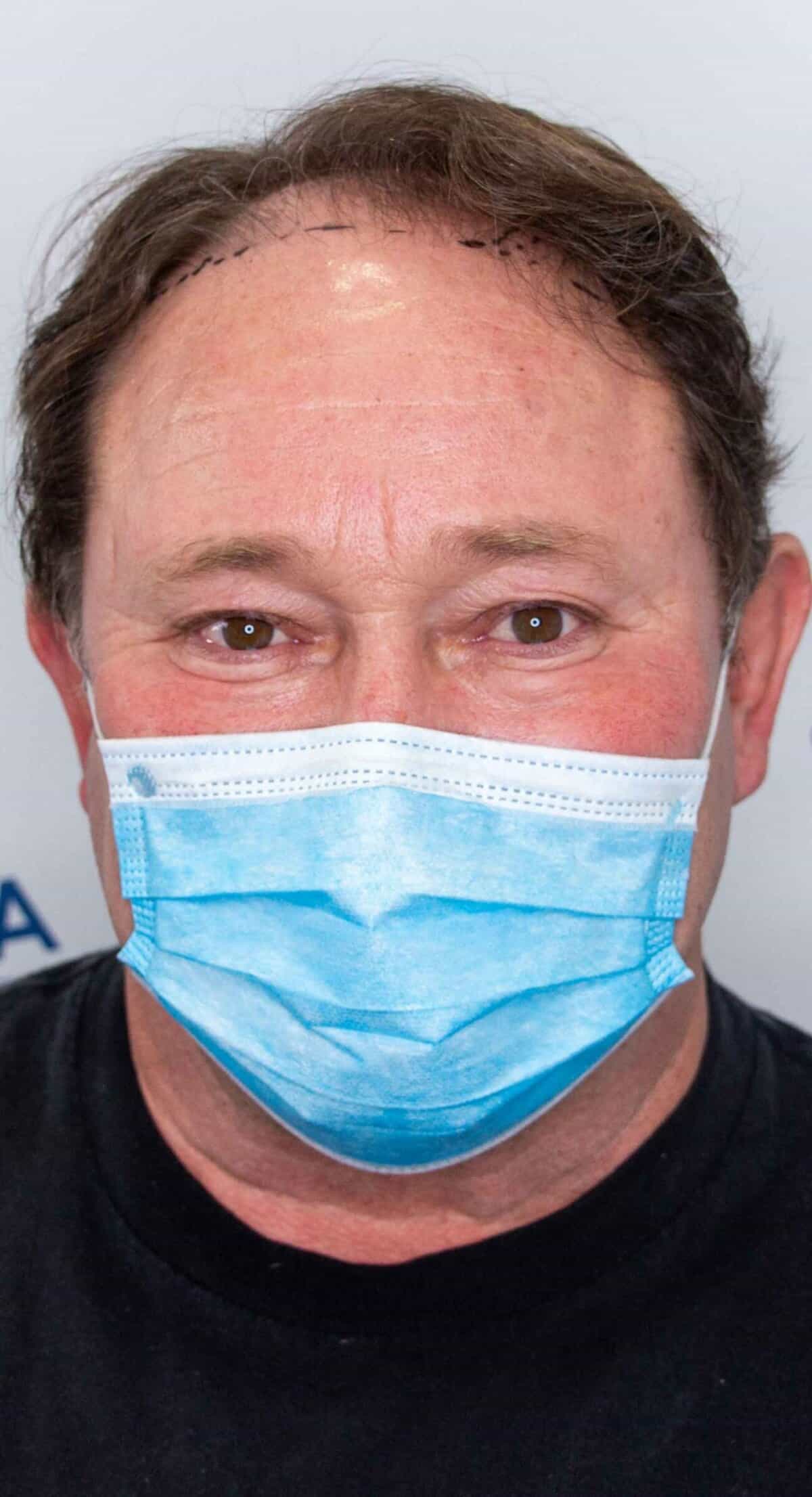 Robert_1_year_Hair_Transplant_Result_Front_hairback_Before