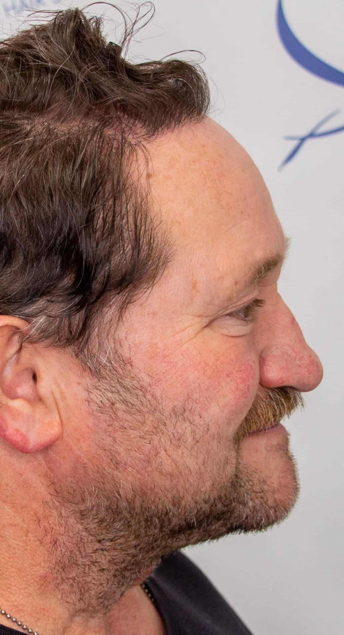 Robert_1_year_Hair_Transplant_Result_Right_After