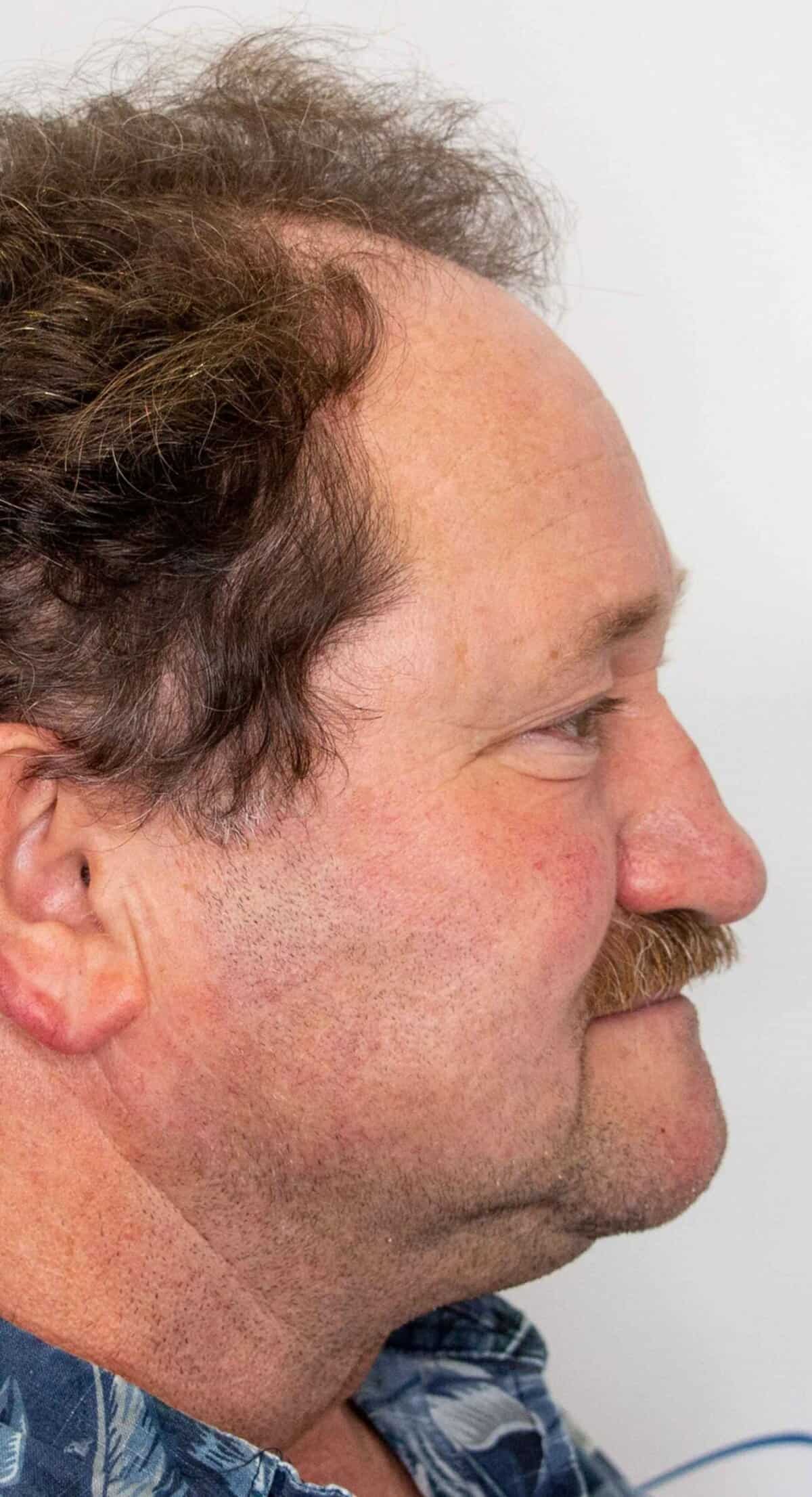 Robert_1_year_Hair_Transplant_Result_Right_Before