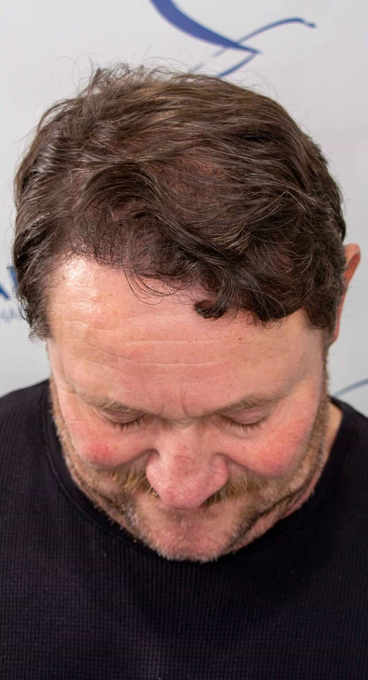Robert_1_year_Hair_Transplant_Result_Top_After