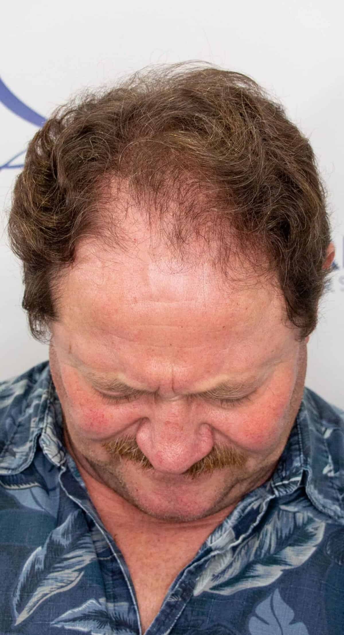 Robert_1_year_Hair_Transplant_Result_Top_Before