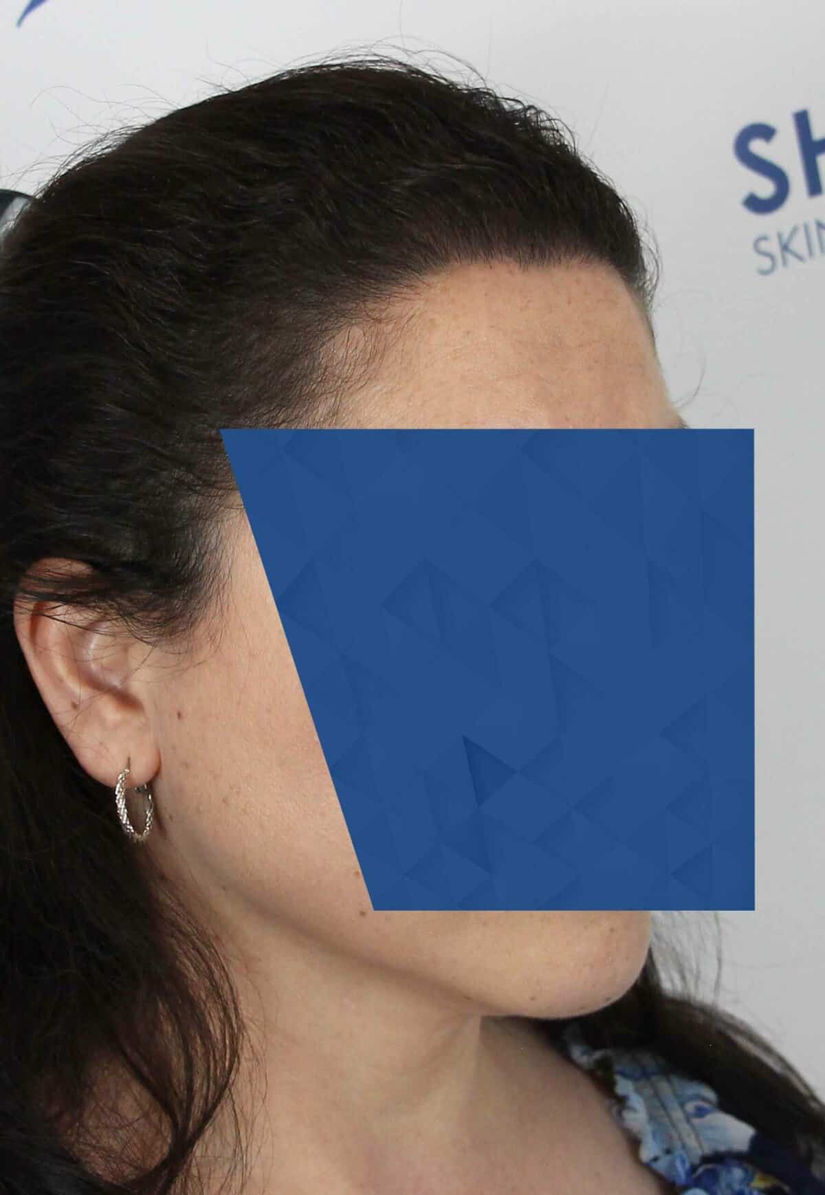 S.H.-After-45Right-scaled