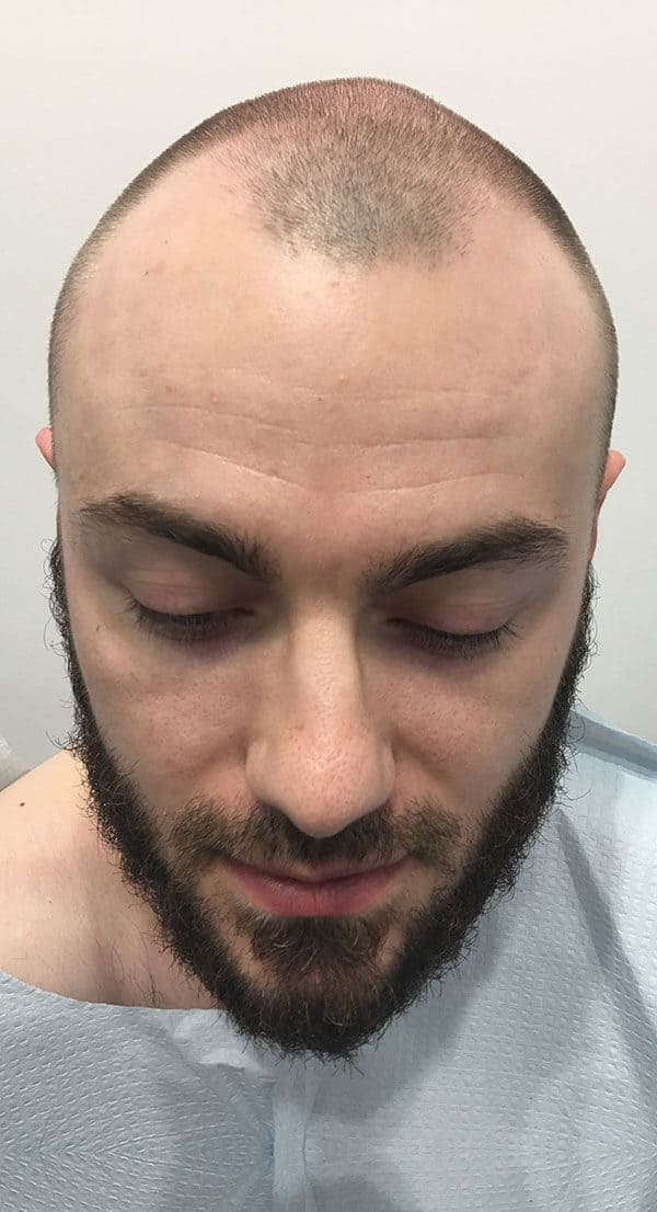 Spencer_Front_Before-1