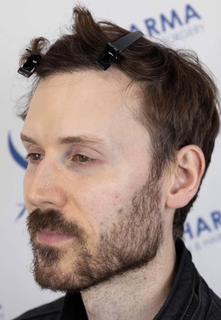 William-After-36yo-2500-grafts-hairline-mid-scalp-45Left