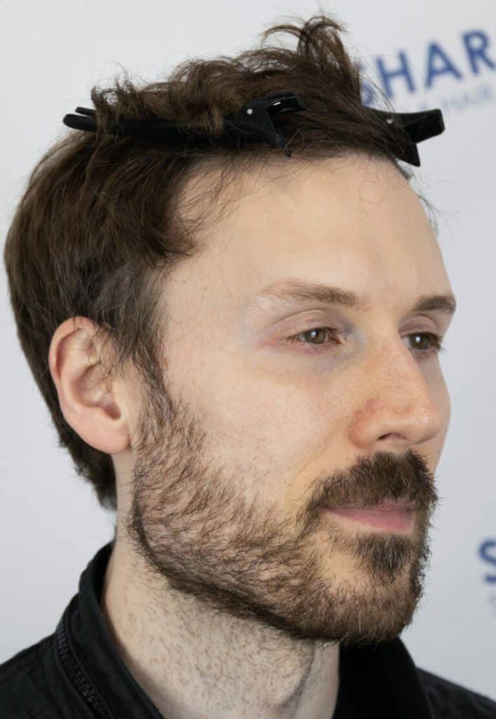 William-After-36yo-2500-grafts-hairline-mid-scalp-45Right